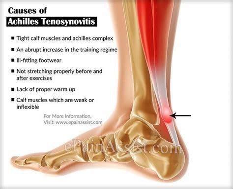 Achilles Tenosynovitissymptomscausestreatmentrecoveryexercises