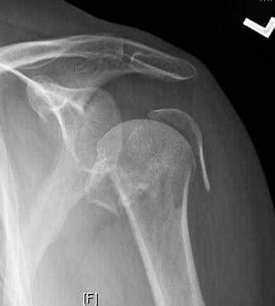 Physical therapy for proximal humerus fracture - fikoscuba