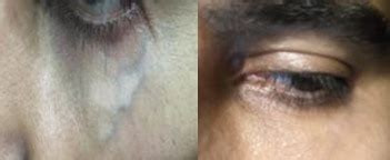 Laser Under Eye Vein Removal Solihull Medical Cosmetic Clinic