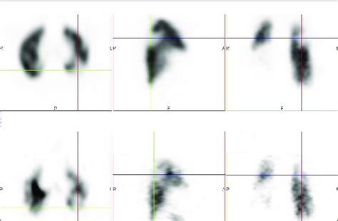 Ventilation Bottom And Perfusion Top Single Photon Emission Download Scientific Diagram