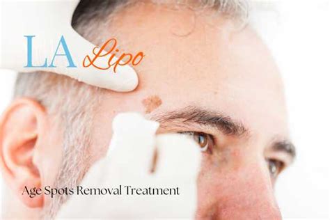 Age Spots Removal LA Lipo