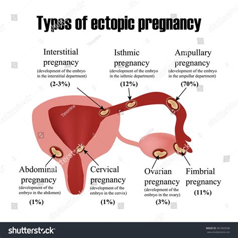 Tipos de embarazo ectópico Infografía Ilustración vector de stock