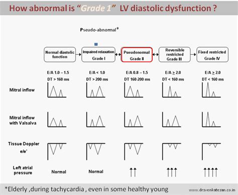 grading of diastolic dysfunction | Dr.S.Venkatesan MD