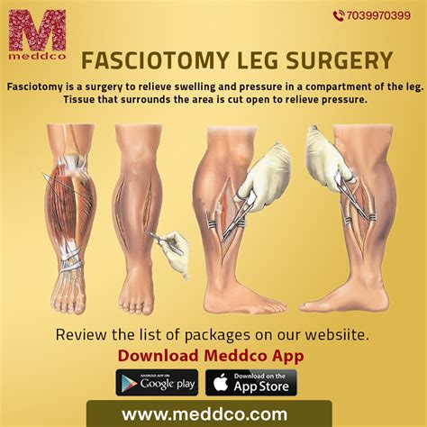 Compartment Syndrome With Fasciotomy Surgery Doctor Stock, 40% OFF