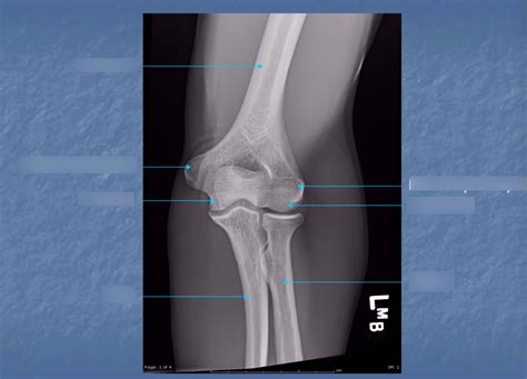 Knee Mri Diagram Quizlet