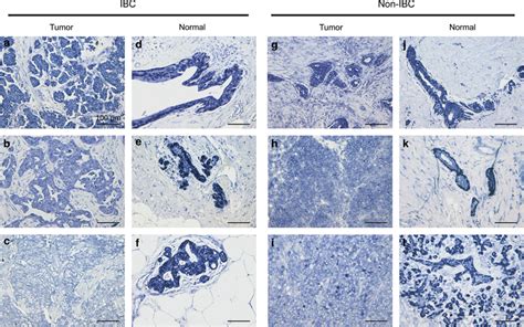 Mir 205 In Situ Hybridization Blue Represents Positive Staining Ac