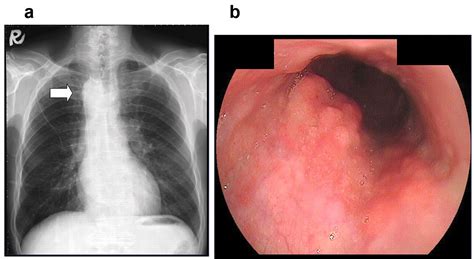 Esophagus Cancer Xray