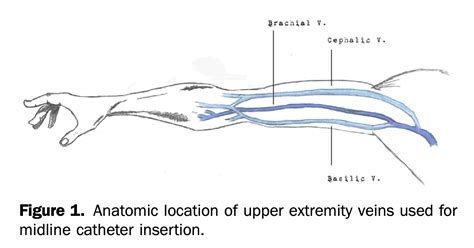 Midline IV Catheters - REBEL EM - Emergency Medicine Blog