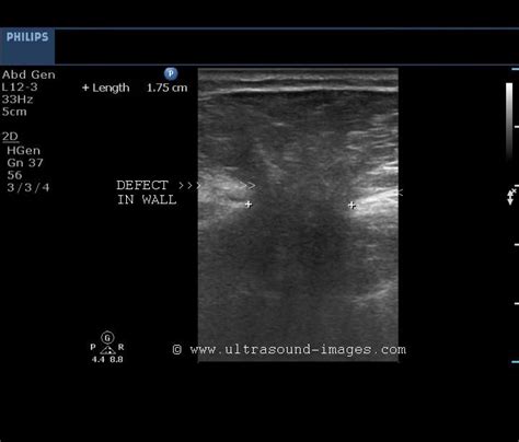 Ultrasound and Color Doppler videos: Ultrasound imaging of large ...