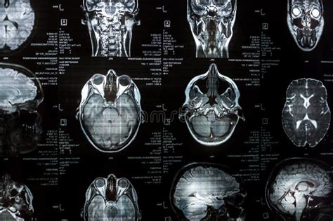 Magnetic Resonance Imaging Of The Brain Close Up MRI Stock Image