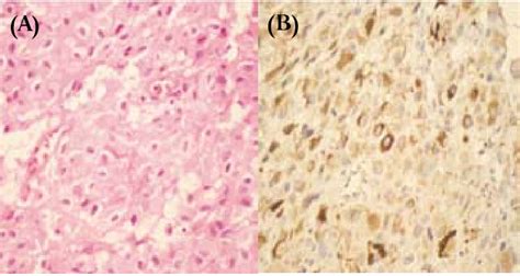 A Tumor De C Lulas Esteroideas Compuesto Por Bloques De C Lulas Con