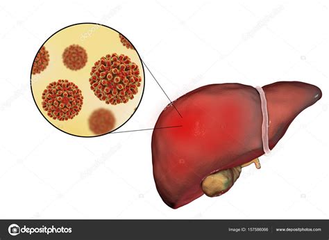 Hepatitis Aguda