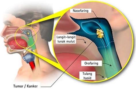 Pengobatan Kanker Nasofaring Homecare