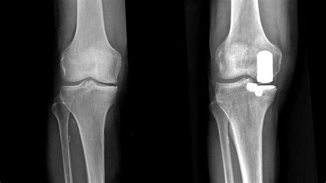 Protesi Monocompartimentale Di Ginocchio FisioScience Medical