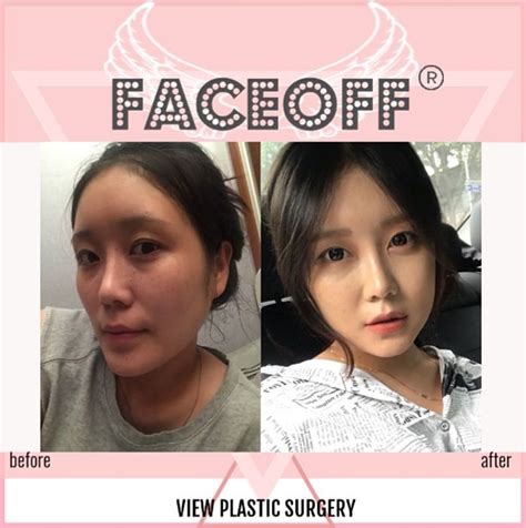 View Plastic Surgery (@view_plastic_surgery) • Instagram photos and videos | Face contouring ...