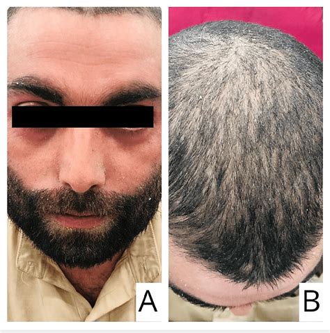 Figure 1 From An Erythrodermic Psoriasis Flare Up With Staphylococcus