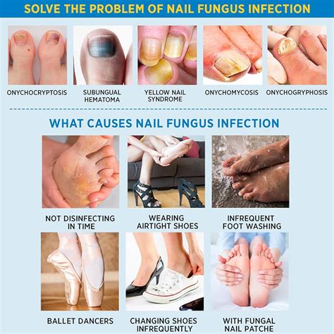 Fungus On Foot Nails Treatments Clearance Emergencydentistry