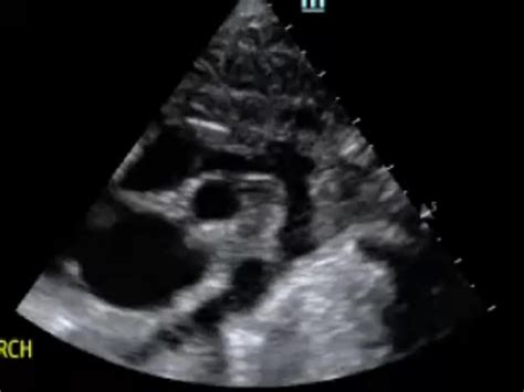 Coarctation Of The Aorta In A Neonate Critical Care Sonography