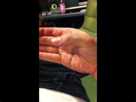 Involuntary thumb shaking - YouTube