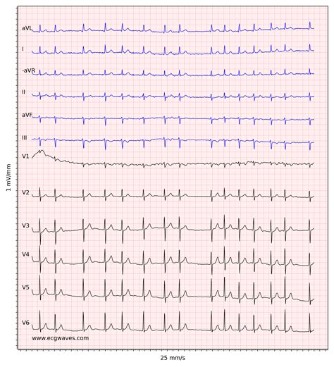 Atrial fibrillation: ECG, classification, causes, risk factors ...