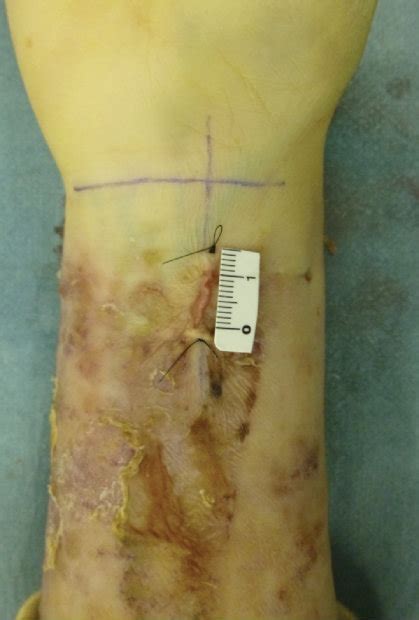 Findings During Operation A Skin Incision Design This Surgical