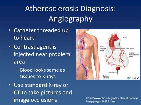 Ppt Lecture 18 Cardiovascular Disease Stroke And Heart Attack