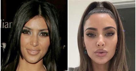 Kim Kardashian Before And After: Plastic Surgery Timeline