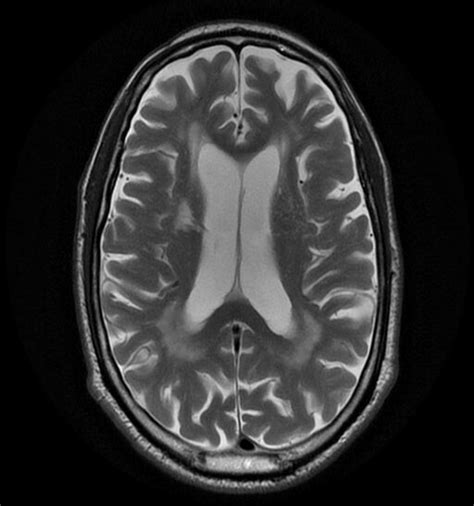 Diffuse brain atrophy in a hypertensive patient. Axial T2WI shows... | Download Scientific Diagram