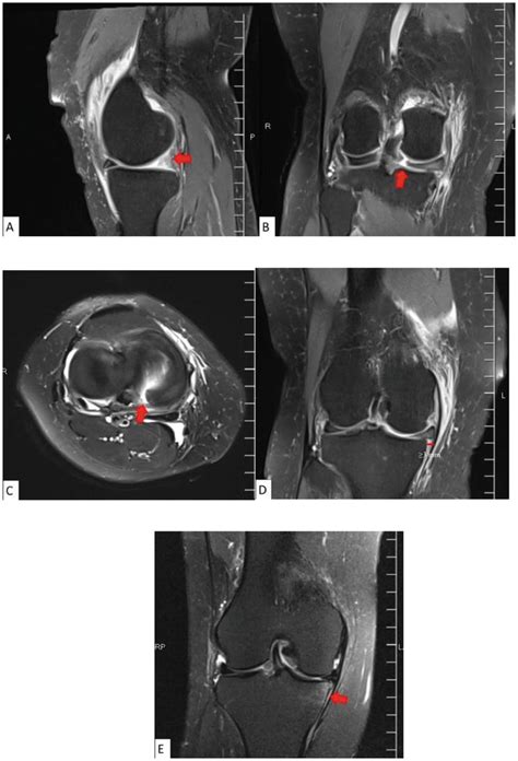 Meniscus Root Tear Mri