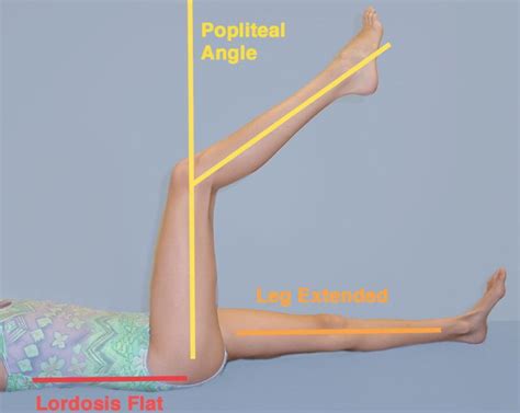 Knee Flexion Deformity In Cerebral Palsy Springerlink