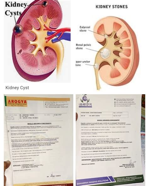 Anechoic Lesion In Kidney | Science Relief