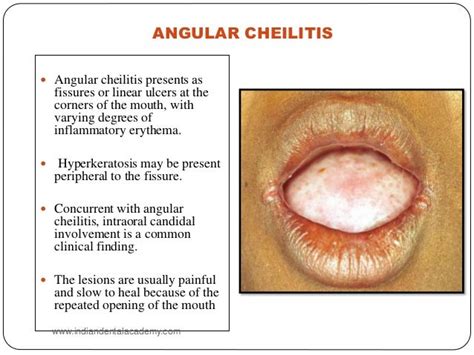 Oral Manifestations Of Hiv Oral Surgery Courses