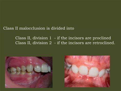 Class II Malocclusion PPT