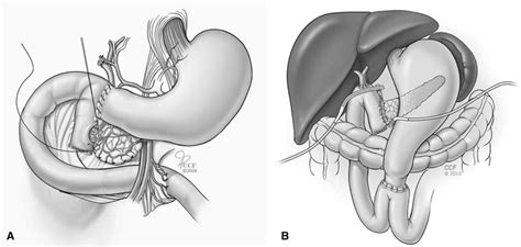 The Prevalence And Significance Of Jejunal And Duodenal Bulb