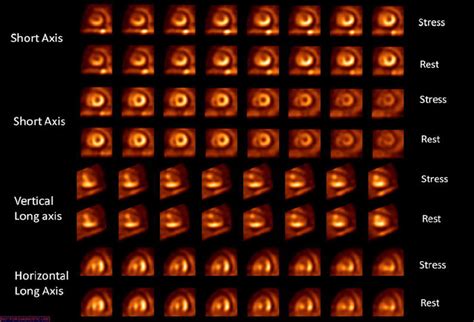 Cardiac Tamponade On Ecg Gated Dipyridamole Pet Perfusion Imaging