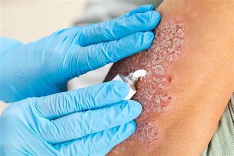 Understanding Psoriasis Causes Symptoms And Treatment Options