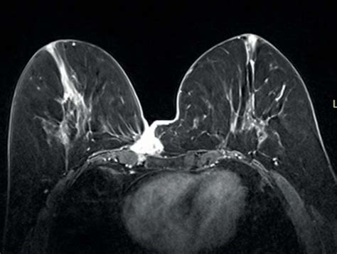 SciELO Brasil Cutaneous Involvement As The Initial Presentation Of