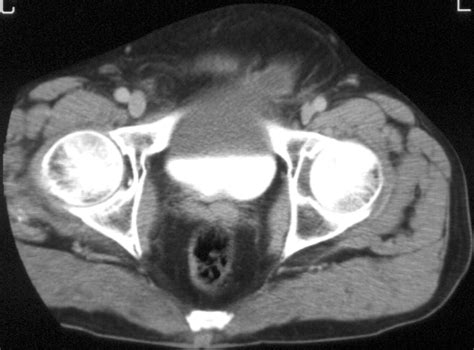 Imaging Of Urinary Bladder Hernias Ajr