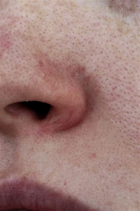 Skin Concerns Rosacea Redness And Sensitivity D Thomas Clinic