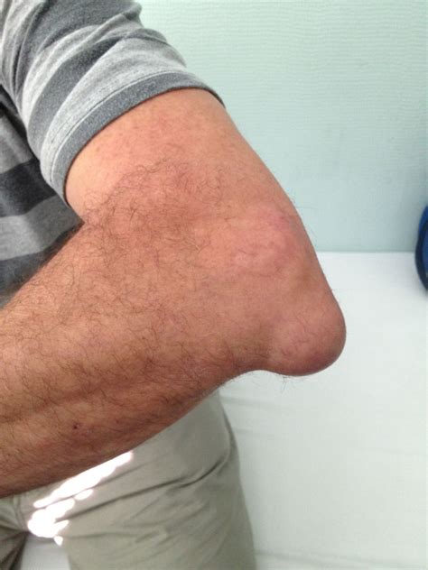 Bursitis Olecrani Doccheck Flexikon