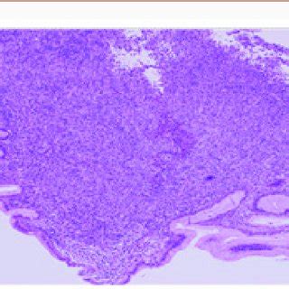 Melanoma cells invading the gastric mucosa. | Download Scientific Diagram