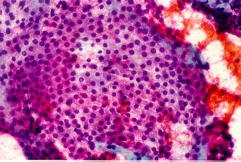 Figure Colloid Nodule Sheath Of Normal Endotext Ncbi