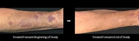 Dr. Siperstein Studies New Treatment for Forearm Bruising - Siperstein ...