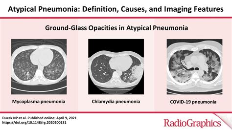 Atypical Pneumonia Definition Causes And Imaging Features