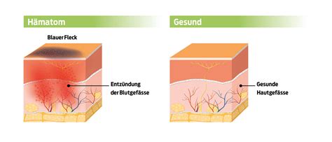 Wundheilung Phasen Und Erste Hilfe