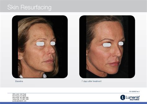 Co2 Laser Resurfacing — Board Certified Dermatology