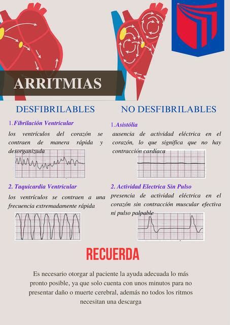 Arritmias Jaime Udocz