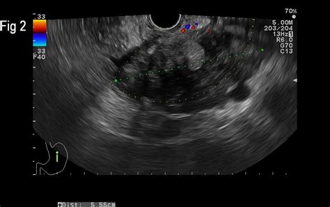 Cystic Liver Metastases Of A Neuroendocrine Pancreatic Tumor [mar 2016