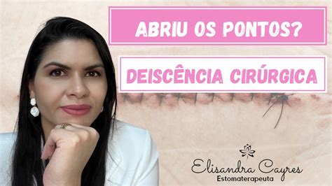 Abriu Os Pontos Ap S Sua Cirurgia Deisc Ncia Cir Rgica Youtube