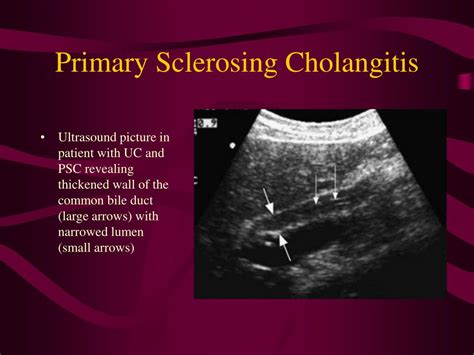 Ppt Radiographic Findings In Ulcerative Colitis And Crohn Disease Powerpoint Presentation Id